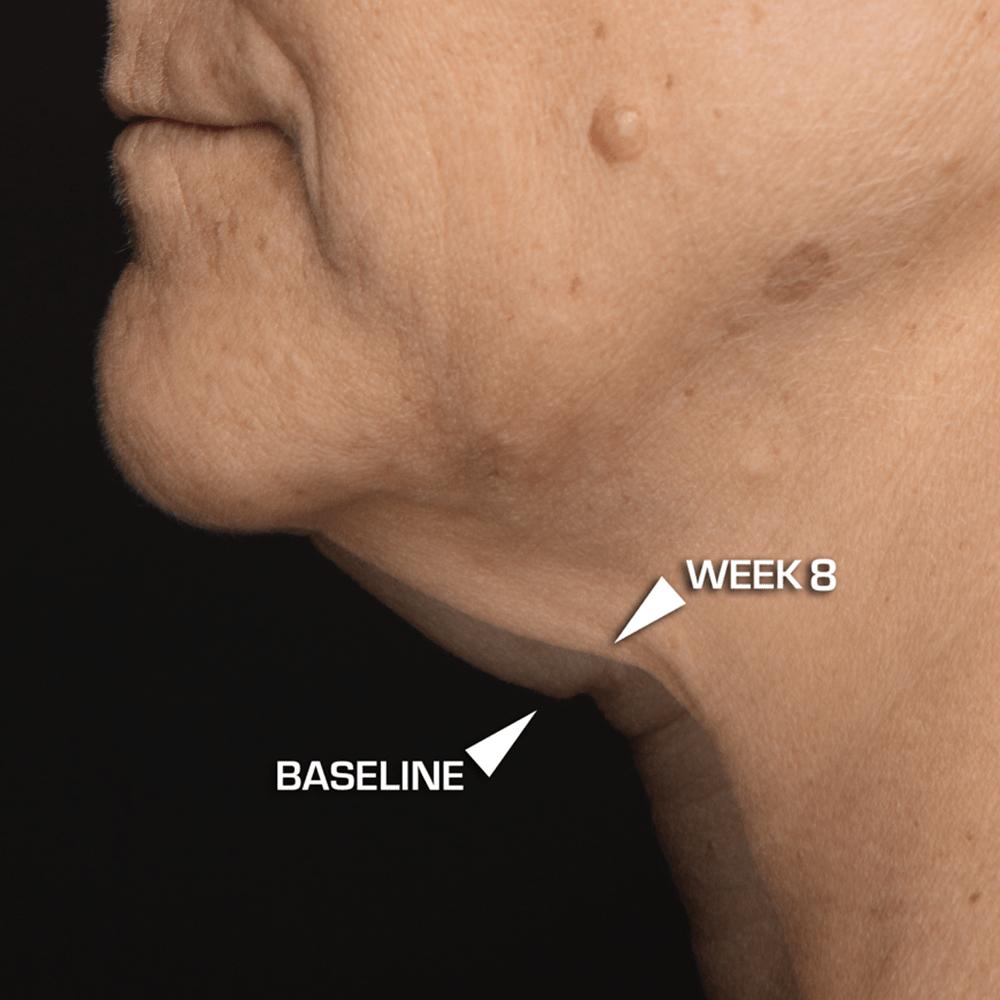  Dr. Brandt Needles No More Neck Sculpting Cream with Gua Sha  Technique. A Medium Weight Cream and Rose Quartz Gua Sha Tool that  Tightens, Smooths, Firms and Hydrates the Neck Area